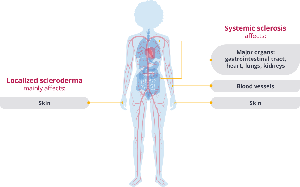 Systemic sclerosis and localized scleroderma effects